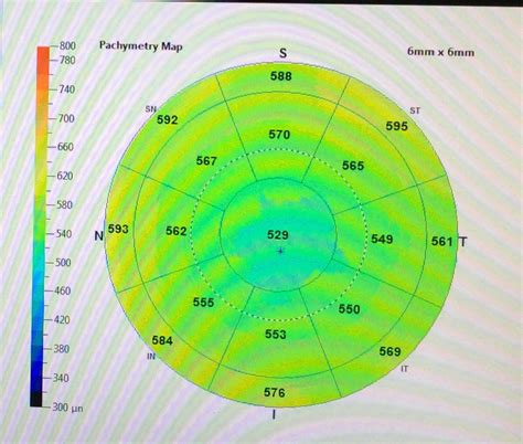 how to measure corneal thickness|average corneal pachymetry.